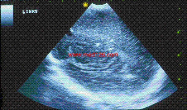 Intracranial calcification.gif (225377 �ֽ�)