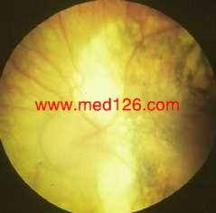 Chorioretinitis.jpg (4631 �ֽ�)