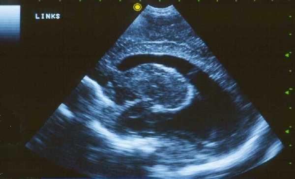 Hydrozephalus.jpg (17739 �ֽ�)